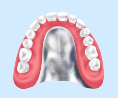 自費の入れ歯（保険適用外：金属床）
