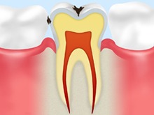 C1：エナメル質の虫歯