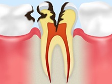 C2：象牙質の虫歯