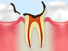 C3：神経の虫歯